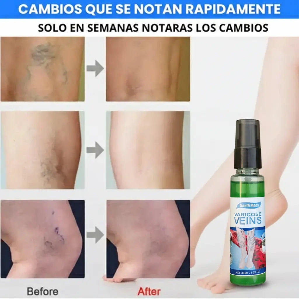 SPRAY V₳RICOSE VEINS™ ⁓ COMBO 2X1 ⁓ Adios varices